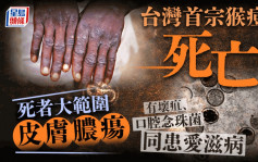 台湾现首宗猴痘死亡个案 皮肤脓疡男死者同患爱滋病