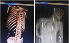 粵建築工人遇意外 遭1.5米鋼筋貫穿身體奇蹟生還