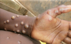 德州录得首宗人类感染猴痘病毒个案 患者曾访尼日利亚