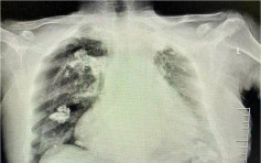 江蘇婦針灸時被扎穿肺 右肺壓縮一半險亡