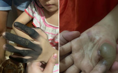 菲7歲女童插拖板遇爆炸險電死 4指被燒黑手掌起大水泡