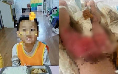 3岁男童意外跌进汤桶22％烫伤 幼儿园被揭牌照已过期