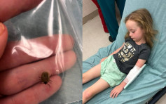 美5歲女童突癱瘓失語 頭髮驚現蜱蟲急送院診治