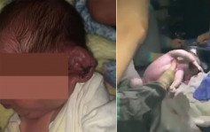 醫院停電醫生堅持手機照明剖腹生產 男嬰左耳慘被切斷