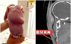 法孕妇子宫破裂 胎儿以背脊塞裂口奇迹救母保命