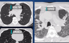 新冠患者肺部傷疤比吸煙嚴重 包括無症狀患者