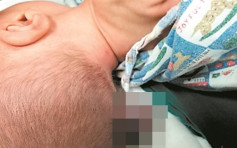 潮汕婦攝取葉酸不足 男嬰出生7天後腦長「尾巴」