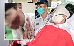 玫瑰崗16歲男生遭筆割左臉 縫70針恐毀容