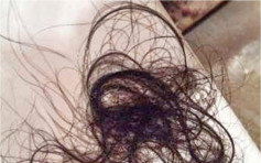 中三女生食头发揭患异食癖 腹痛送院开刀取出大团毛发 