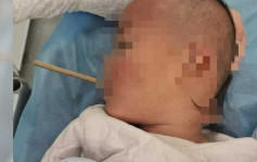 插筷子食苹果跌倒 2岁童插穿喉咙后颈惊凸
