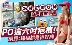 24岁花滑女神自揭曾入院做手术 PO逾六寸长疤痕 网民：睇相都觉得好痛