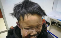 湖南郴州13岁少年烧炮仗遇哑炮 炸至面目全非