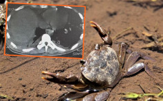 貴州男子誤信傳聞生食蟹 全身感染寄生蟲多器官衰竭