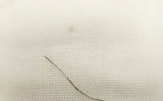 京漢「自行針灸」治腰痛 10厘米長針斷體內送院