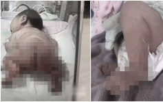 女婴疑被产科护士严重烫伤 医院曾辩称「天生皮肤病」