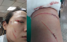台北驚現挖眼案翻版 女子提醒鄰居戴口罩遭鎅刀襲擊濺血