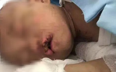 安徽​5岁女童遭亲生父母虐待 伤口溃烂发臭引苍蝇围绕