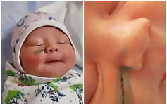 俄女剖腹生產驚見女兒臉上現3厘米疤 醫生辯稱：女嬰不應亂動