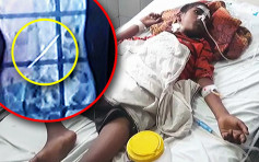 印度少年吞牙刷鐵釘治異食癖 腹痛送醫取出