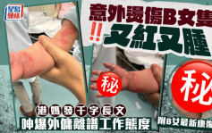 意外燙傷B女隻手又紅又腫 港媽發千字長文 呻爆外傭離譜工作態度（附B女最新康復情況）｜Juicy叮