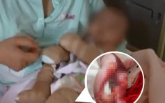【有片】初生女婴患罕见「无皮」病 手腿无皮肤不停渗血