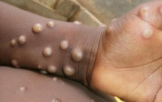 巴西及西班牙首現猴痘死亡病例 非洲以外國家首例
