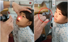女童難忍鼻痛 醫生從其鼻腔夾出7厘米長活水蛭