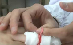 家长错误包扎酿祸 3岁女童手指受伤要截指