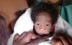 南非女嬰患罕見病滿臉皺紋遭嘲笑似老太婆 家人超心痛