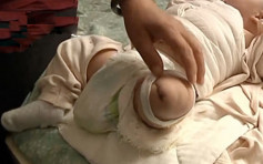 河南護士忘關風筒　害初生男嬰燙傷需截肢