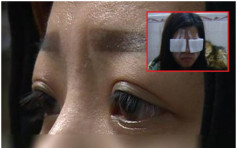 粵女紋眼線險失明 疑遭電筆灼傷眼角膜