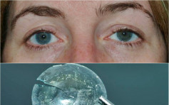 英妇左眼肿痛求医 揭眼藏隐形眼镜28年