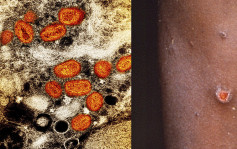 印度發現首宗猴痘死亡病例 蘇丹報告首宗病例