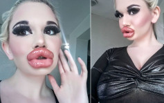 保加利亞女子打30次針豐唇變「孖潤腸」 醫生警告：快堵住鼻孔了