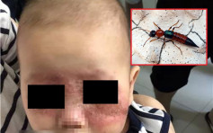 1歲童戶外遭隱翅蟲纏繞 拍打後毒液致「毀容」