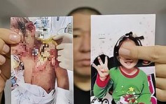 遼寧6歲女童遭母拔牙滾水燙 父促嚴懲盼奪回撫養權