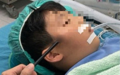 兄持玩具弓箭誤射7歲弟 箭插入臉險傷及眼球與臉部神經