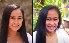 菲律宾16岁少女患早衰症 2年间极速老化似50岁