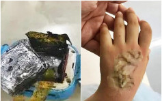 兒童智能手表突自燃 福建4歲女童手背嚴重燒傷