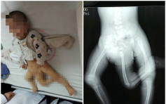 2骨盆3条腿 男婴现罕见臀部寄生胎