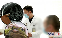 上海男欲治病輕信偏方生吃小青蛙 致寄生蟲入腦