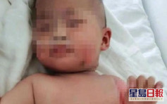 杭州6個月大女嬰被燙傷 外公用「白酒毛巾」包裹致休克