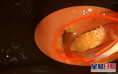 廣東男常生食淡水魚蝦 體內肝臟排出活蟲