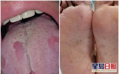 西班牙研究發現染疫新病徵 舌頭發炎及手腳出疹起紅點