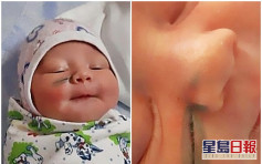 俄女剖腹生產驚見女兒臉上現3厘米疤 醫生辯稱：女嬰不應亂動