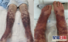 34歲女接種阿斯利康疫苗現嚴重過敏 手腳長滿血泡險截肢