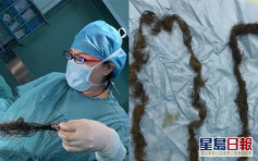武汉女卵巢藏畸胎瘤 医生取出2米毛发