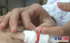 家長錯誤包紮釀禍 3歲女童手指受傷要截指