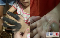 菲7岁女童插拖板遇爆炸险电死 4指被烧黑手掌起大水泡