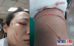 台北驚現挖眼案翻版 女子提醒鄰居戴口罩遭鎅刀襲擊濺血